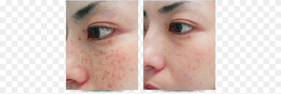 Ocean State Laser Amp Aesthetics Brown Spot Removal Apple Cider Vinegar Sunspots Before And After, Face, Freckle, Head, Person Png