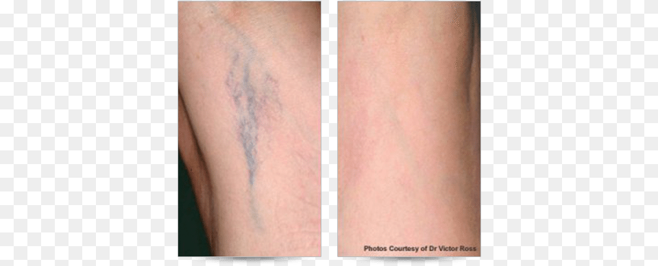 Ocean State Laser Amp Aesthetics Spider Viens Spider Capillaries Showing Through Skin, Body Part, Person, Knee, Adult Png