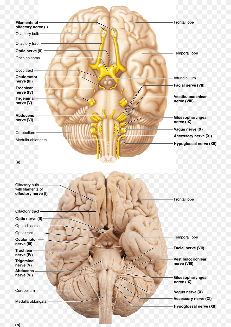Olfactory Bulb Optic Nerve Download, Ct Scan, Head, Person, Face Png