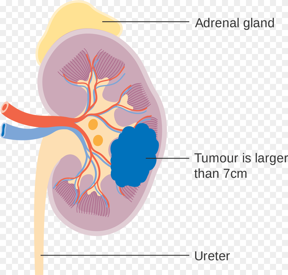 Open Kidney Cancer Diagram, Ct Scan Free Transparent Png