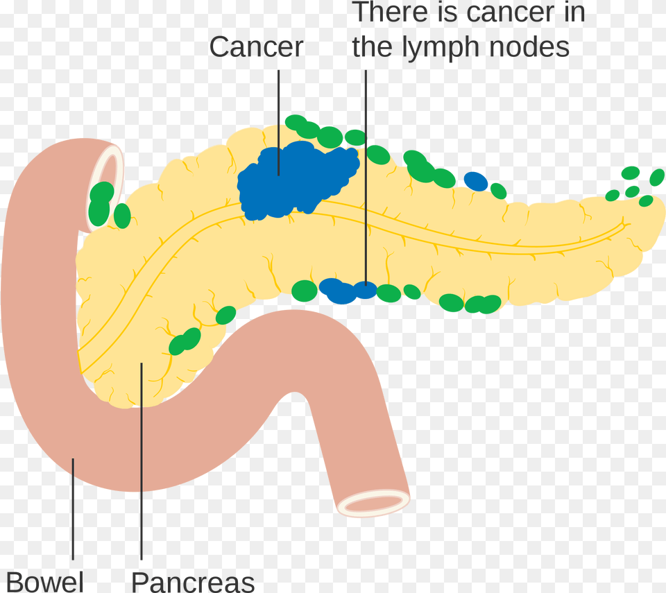 Open Pancreatic Cancer Diagram, Chandelier, Lamp Png
