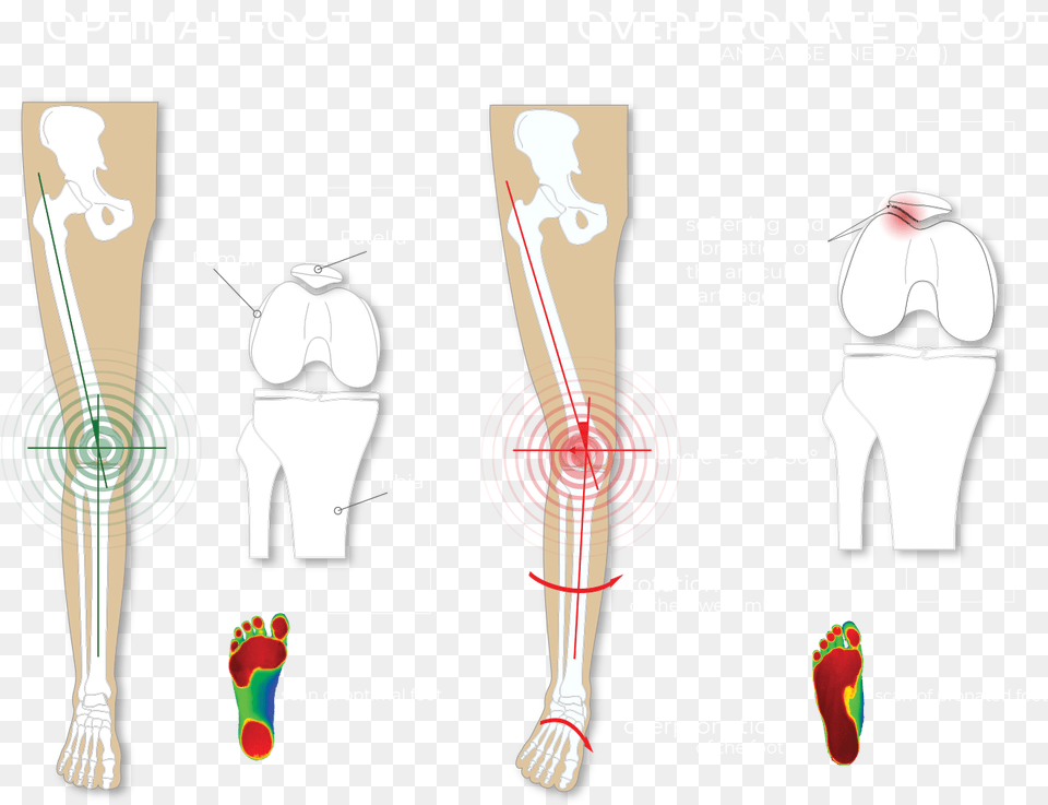 Optimal Foot Vs Over Pronated Foot And Knee Pain Pronation Foot, Ct Scan, Adult, Female, Person Free Transparent Png