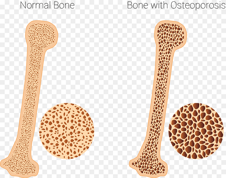 Osteoporosis Clinic Healthy And Osteoporotic Bone, Food, Honey, Cutlery, Spoon Free Png