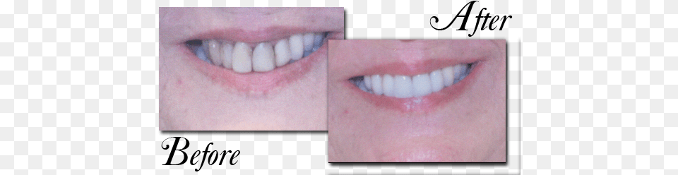 Our Patient Had Existing Old White Fillings In Her White Fillings Front Teeth, Body Part, Mouth, Person, Baby Png Image