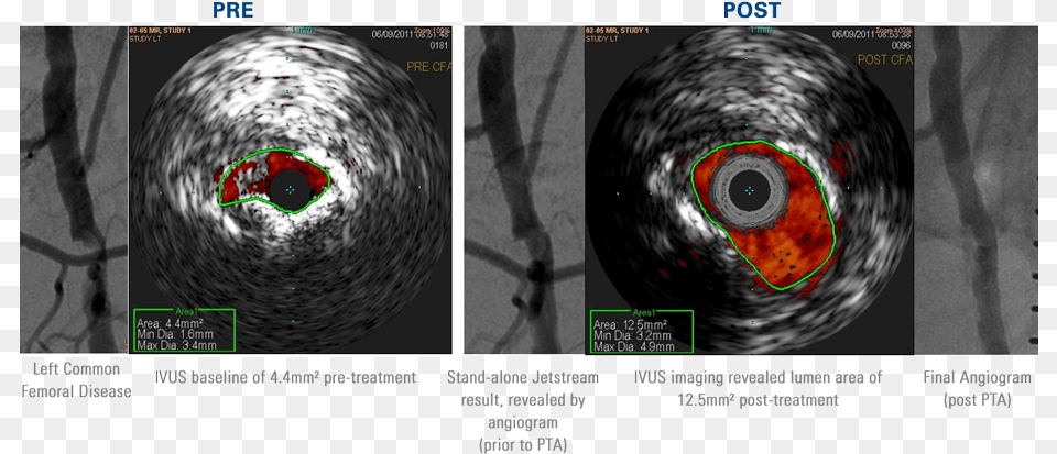 Outstanding Luminal Gain In Calcified Eccentric Common Atherectomy Ultrasound, Nature, Outdoors, Night, Hurricane Free Transparent Png