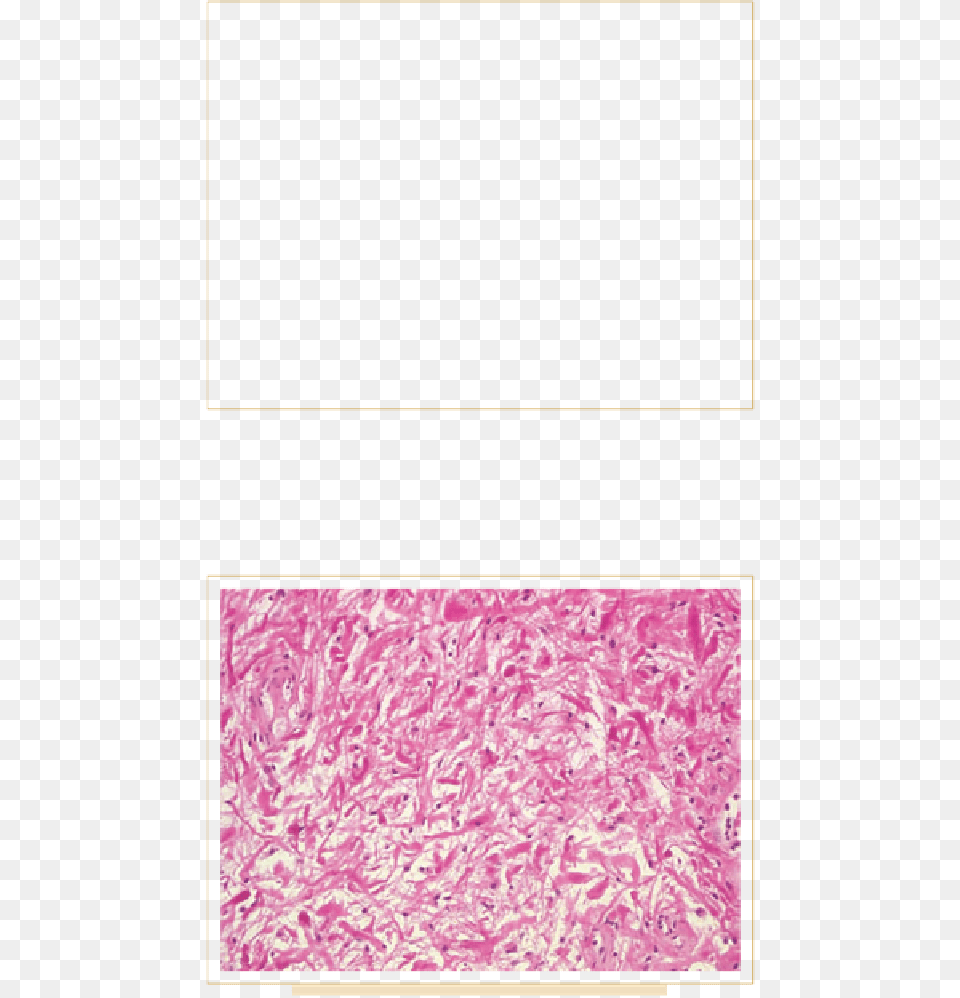 Overview Of Pathology And Treatment Of Primary Spinal Paper Product, Purple, Home Decor, Towel Png Image