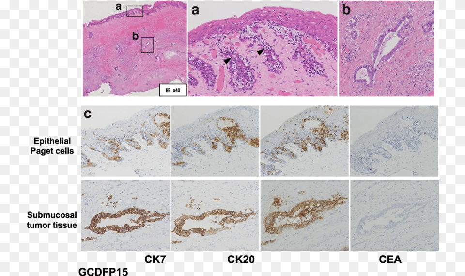 Paget Cells Were Scattered In Squamous Epithelium Arrow Cea Paget, Stain, Paper Free Png