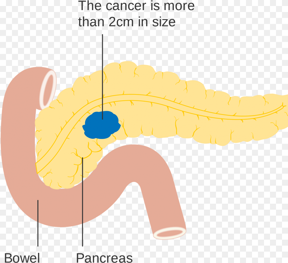 Pancreatic Cancer, Body Part, Stomach Png Image