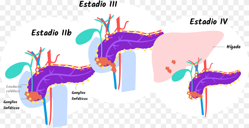 Pancreatic Cancer Stage 4 Tumor, Chart, Plot, Diagram Png