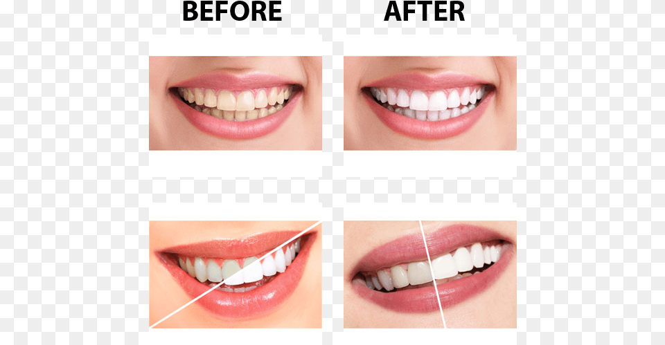 Parodontax Toothpaste Before And After, Body Part, Mouth, Person, Teeth Free Png Download