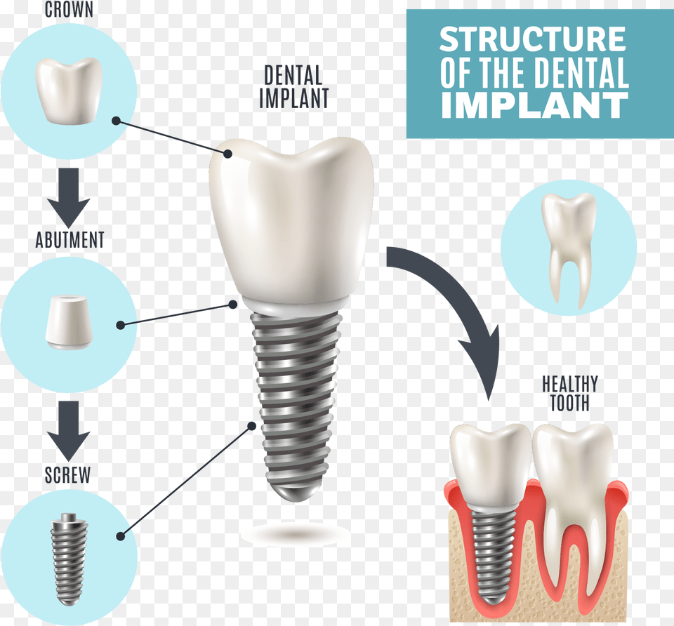 Part Of Dental Implant, Light, Machine, Screw Png Image