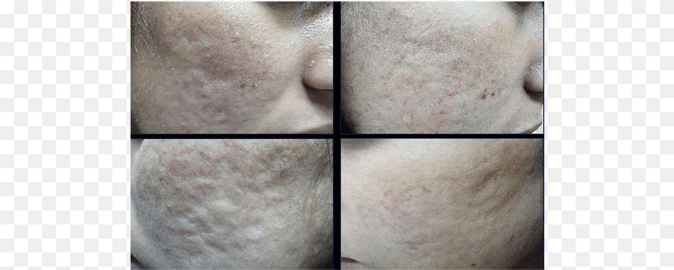 Patient With Rolling Acne Scar Before And Six Months Freckle, Head, Person, Face, Skin Free Png