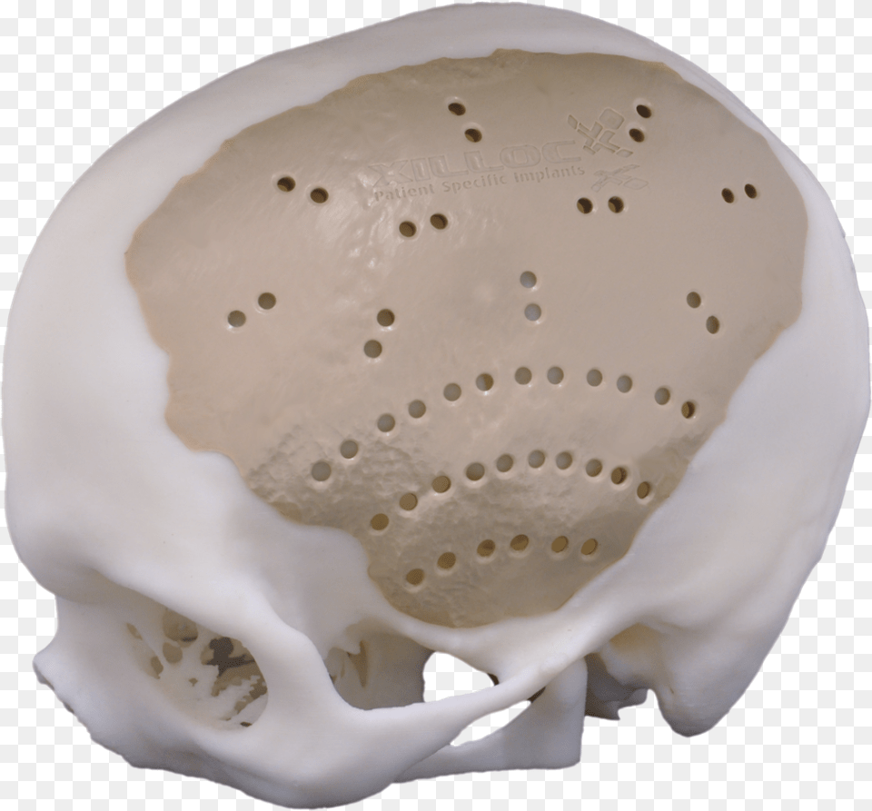 Peek Cranial Implant, Head, Person, Ct Scan, Face Free Transparent Png