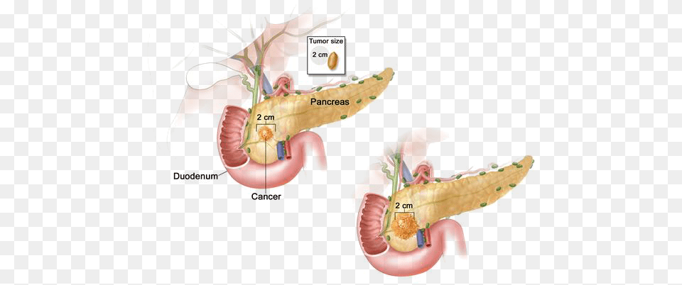 Periampullary Neoplasms Stage 1 Pancreatic Cancer, Baby, Person Png