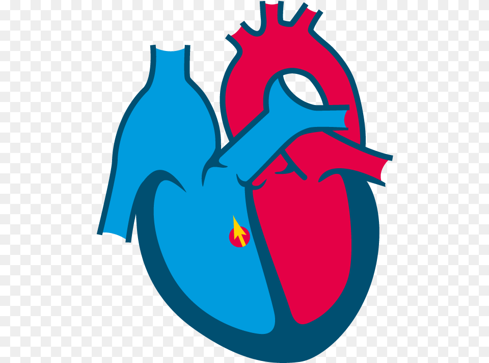 Perimembranous Vsd Congenital Heart Disease Clipart, Water Png Image