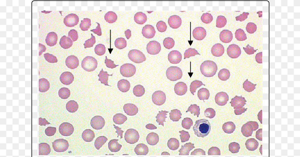 Peripheral Blood Smear Of A Patient With Microangiopathic Pernicious Anemia Blood Smear, Stain Free Png Download
