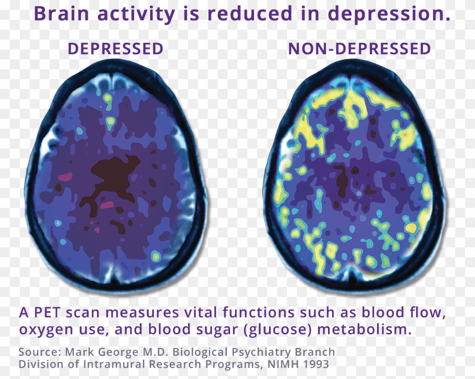 Pet Scan Comparing Depressed Brain To Non Depressed Tms Depression, Ct Scan, Plate Free Png Download