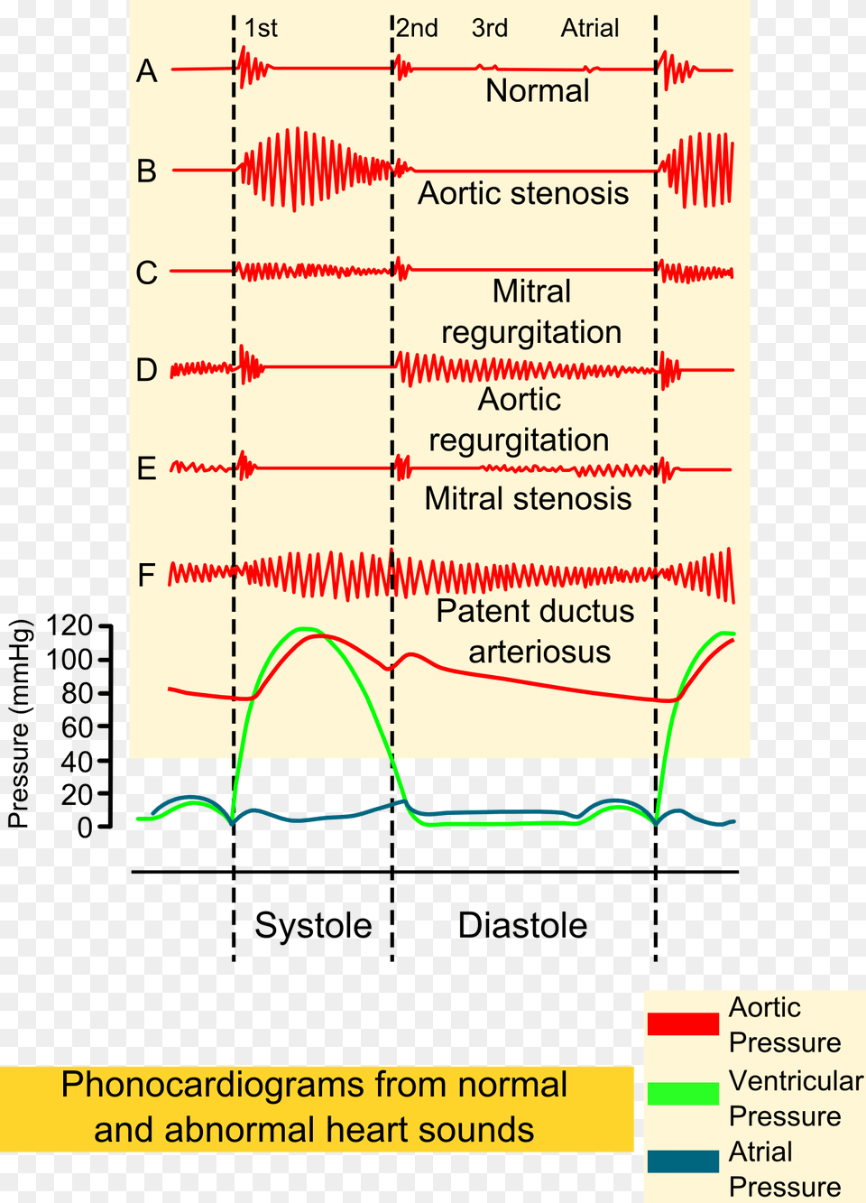 Phonocardiograms From Normal And Abnormal Heart Sounds, Chart, Plot Png Image