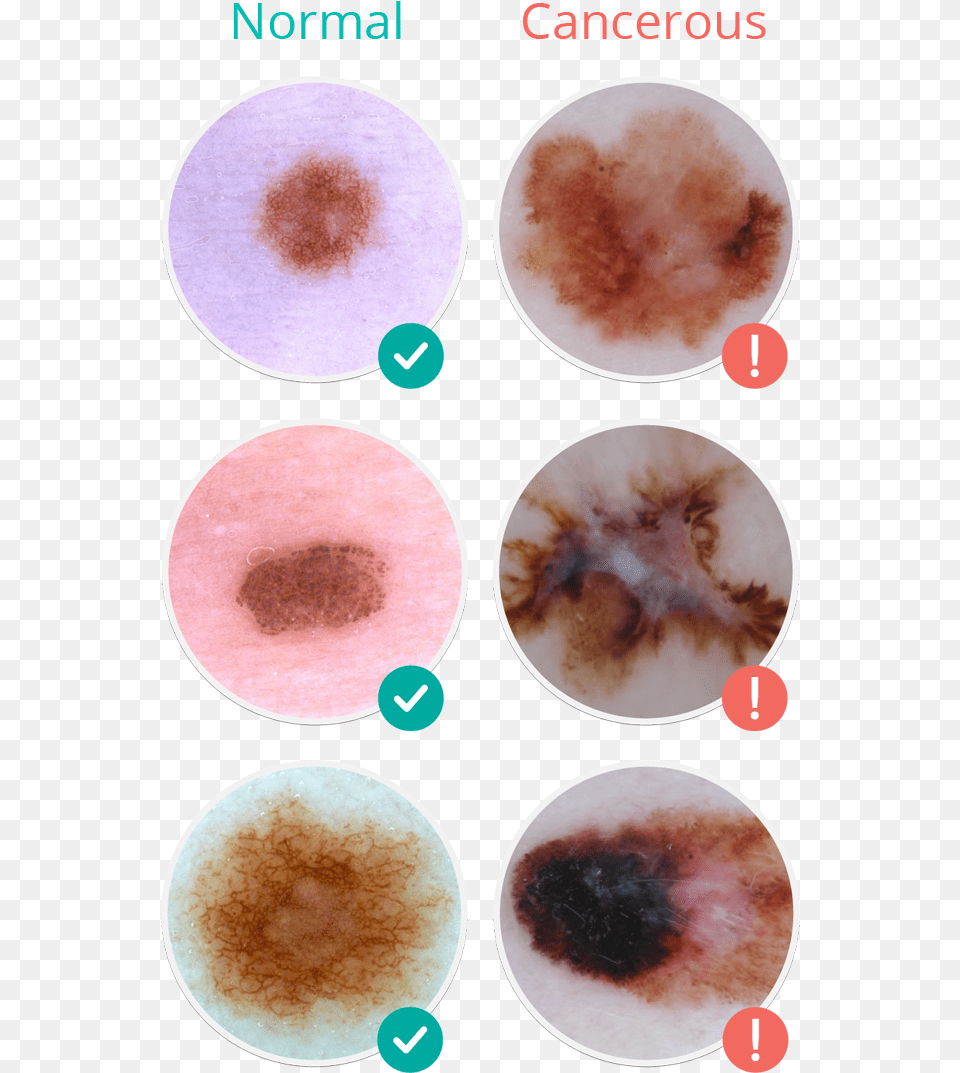 Photo Content Skin Cancer Mole, Face, Head, Person, Stain Free Png Download