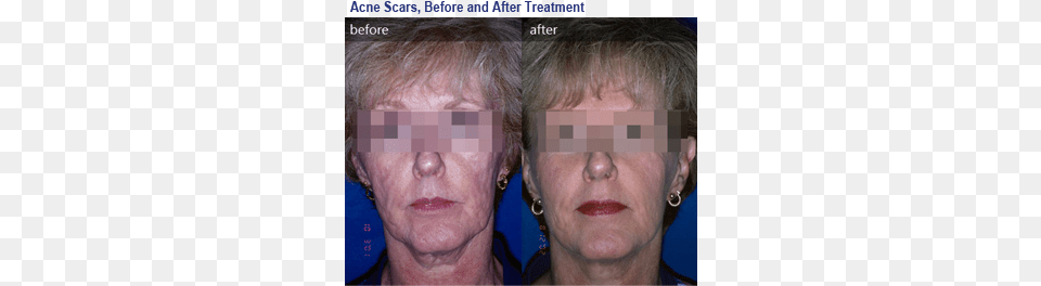 Photo Of Before Amp After Acne Scaring Deep Rolling Acne Scars Chin, Accessories, Earring, Face, Head Free Png