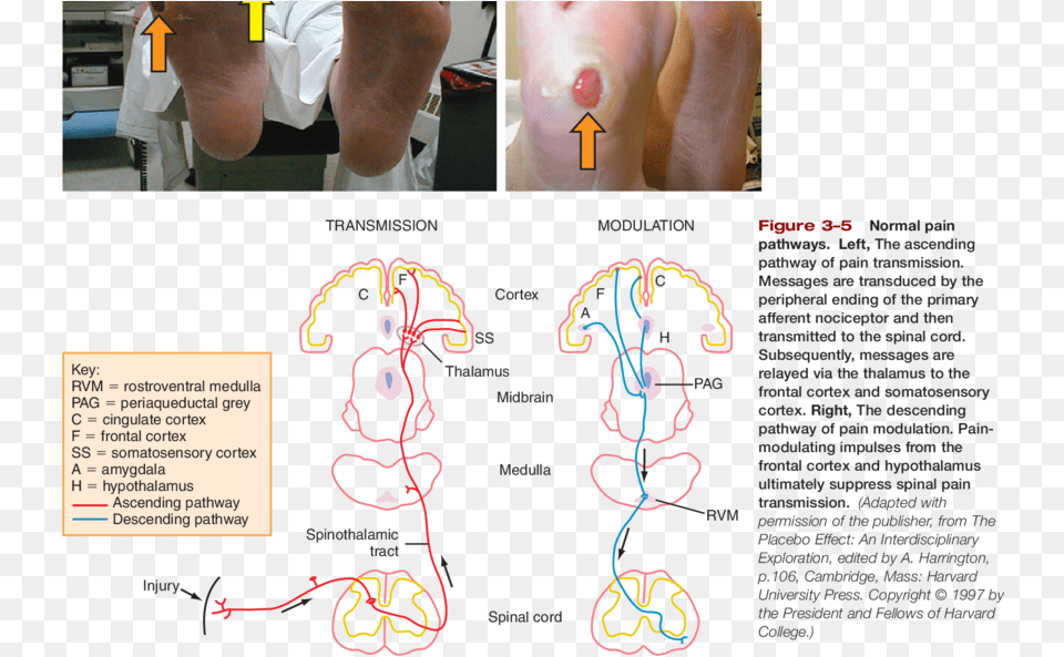 Photos Of Claw Toes Foot Deformity Green Arrow Diagram, Adult, Person, Man, Male Png Image