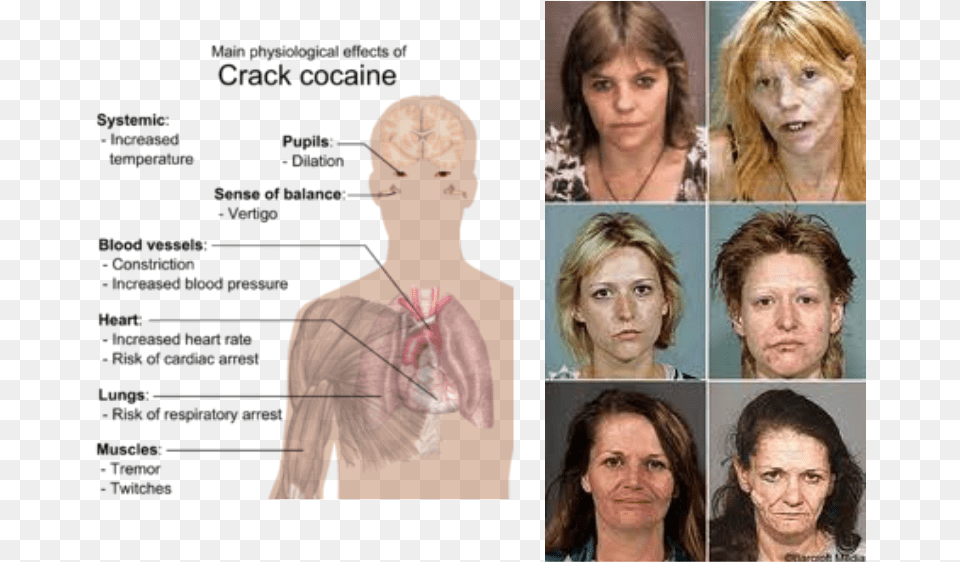 Picture Effects Of Crack Cocaine, Adult, Body Part, Face, Female Free Transparent Png