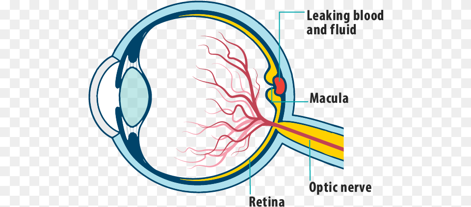 Picture Of Effects Of Wet Amd On The Eye Showing Leaking Eye Retinal Blood Vessel, Ct Scan, Racket, Person, Face Png Image