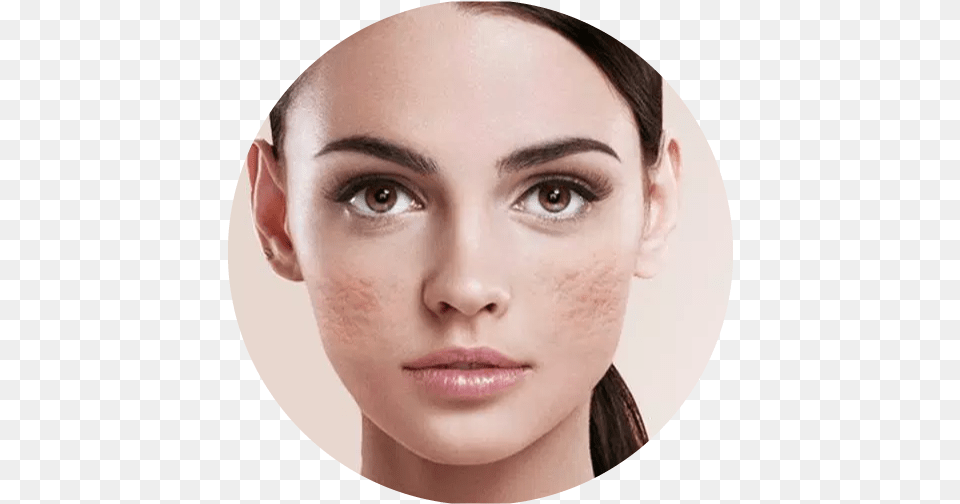 Pimple Acne Scar Removal Treatment In Ratio Of Beautiful Face, Head, Person, Photography, Adult Png Image