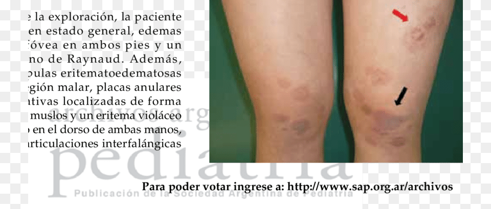 Placas Eritematosas Violceas Y Ligeramente Descamativas Erythema, Body Part, Knee, Person, Skin Free Transparent Png