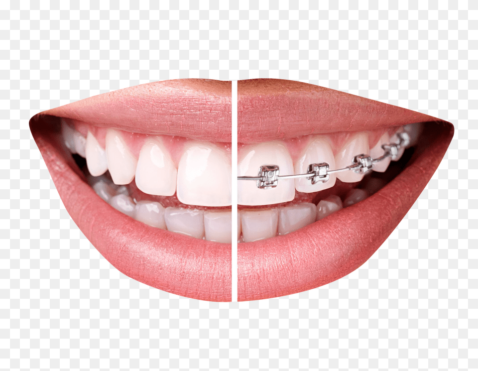 Pngpix Com Teeth With Braces Image, Body Part, Mouth, Person, Face Free Transparent Png