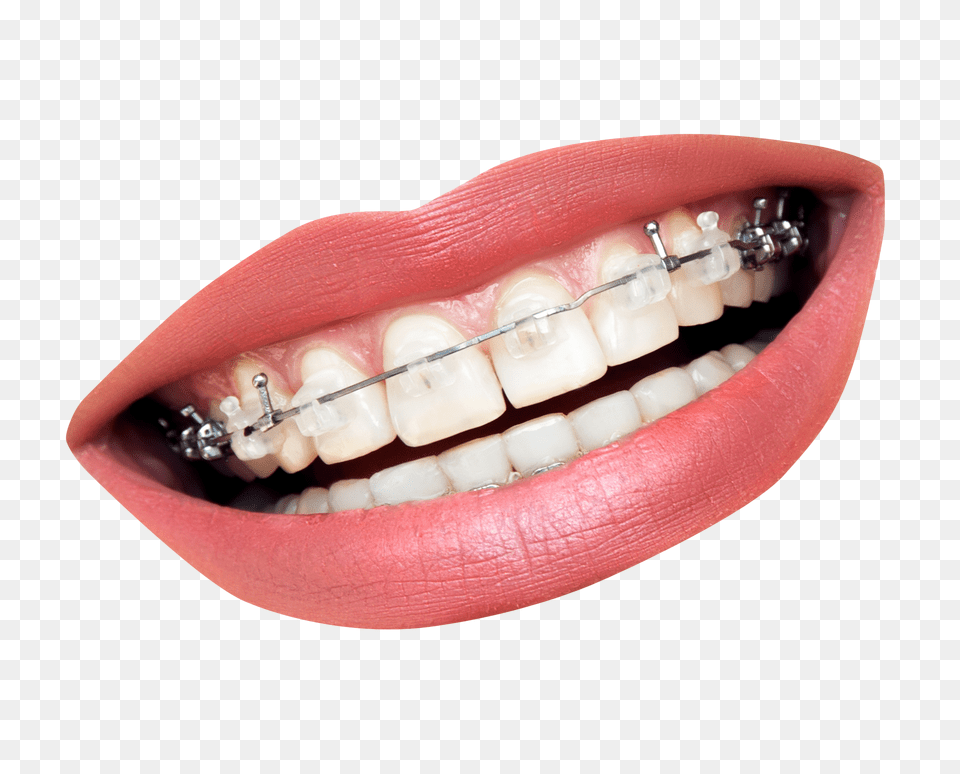 Pngpix Com Teeth With Braces Image, Body Part, Person, Mouth, Head Free Transparent Png