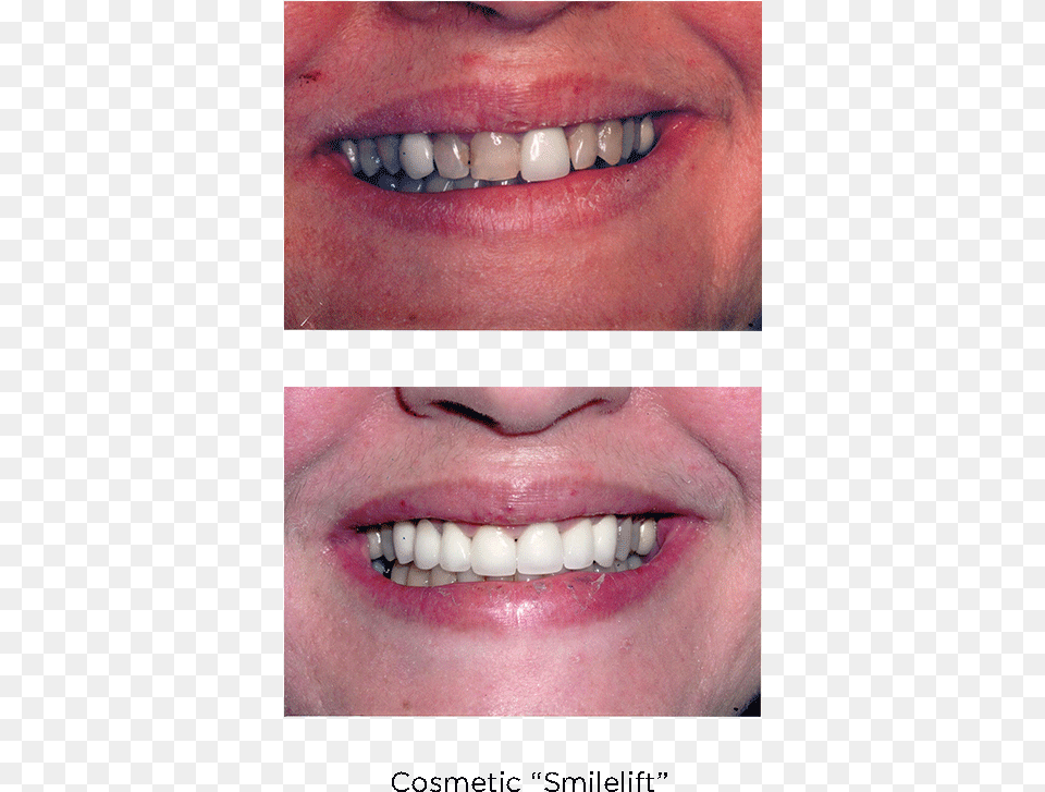 Porcelain Veneers Cosmetic Dentistry, Body Part, Mouth, Person, Teeth Free Png