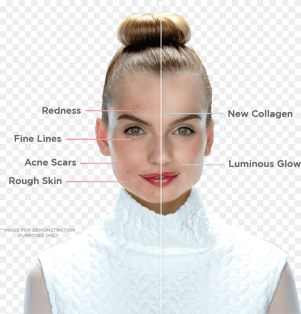 Portrait Photo With Left Side Of Face Before Treatment Laser Facial Treatment, Adult, Person, Woman, Female Png Image