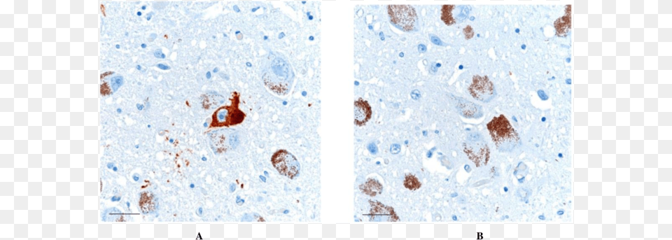 Positive Neurofibrillary Tangle Is Noted In The Neurofibrillary Tangle, Stain Free Transparent Png