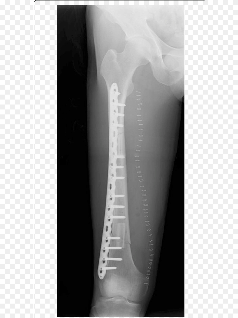 Postoperative Radiography After The Femur Reconstruction X Ray, X-ray, Adult, Bride, Female Free Png