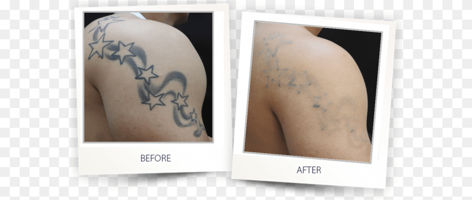 Pre Treatment Clearlift Tattoo Removal, Person, Skin Png