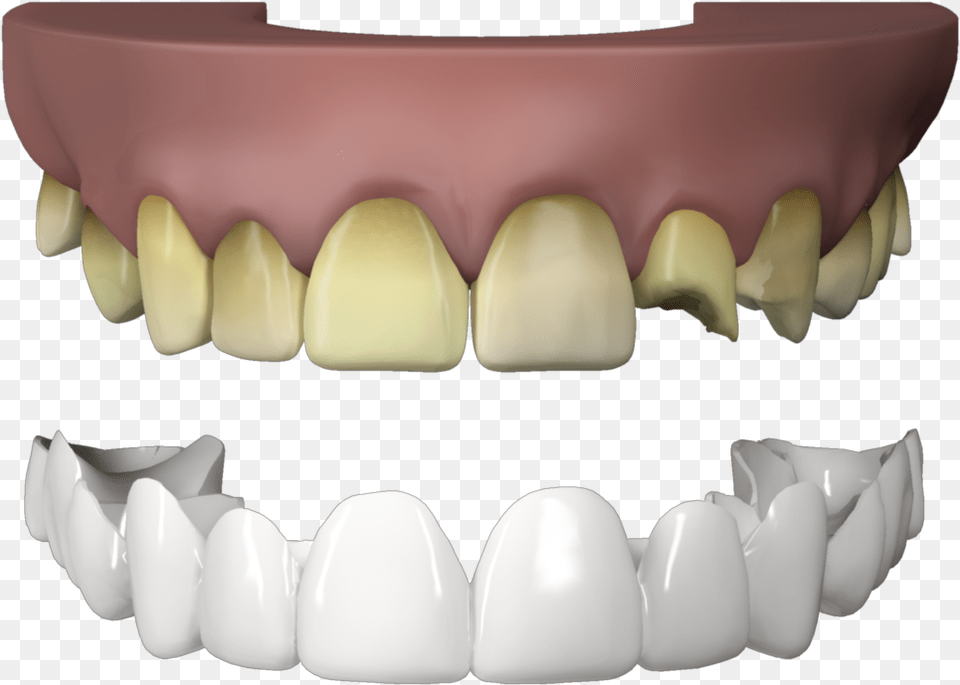 Press On Veneers Teeth Fang, Body Part, Mouth, Person, Face Png Image