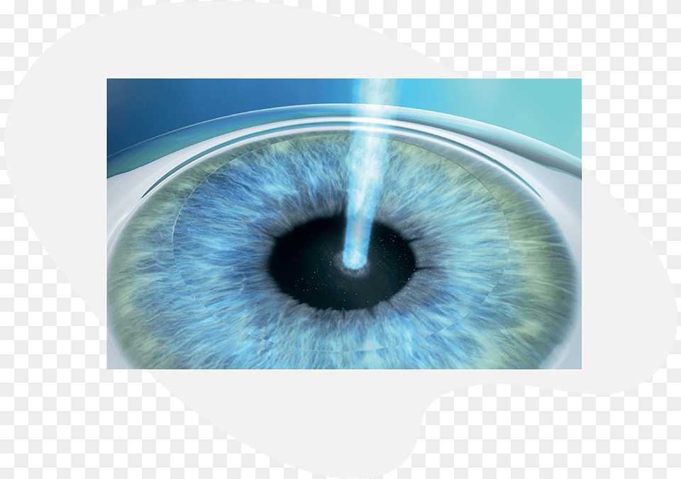 Prk Treatment With Excimer Laser Bandage Contact Lens After Prk, Contact Lens Free Transparent Png
