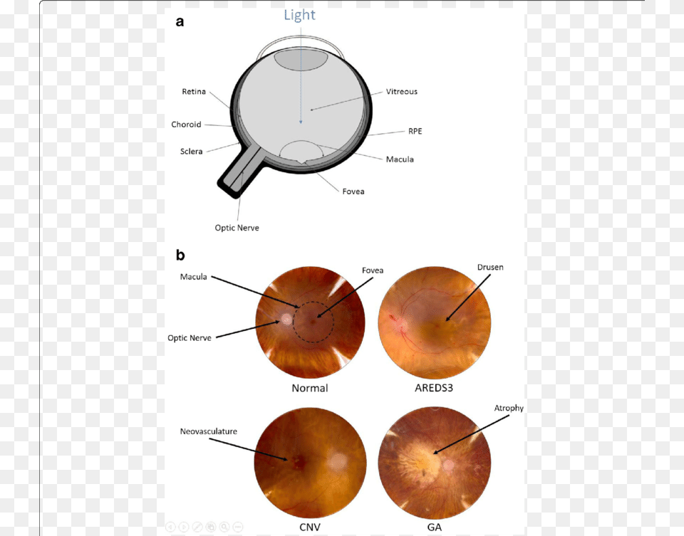 Progression Of Age Related Macular Degeneration Fundus Photography, Sphere, Cup Free Transparent Png