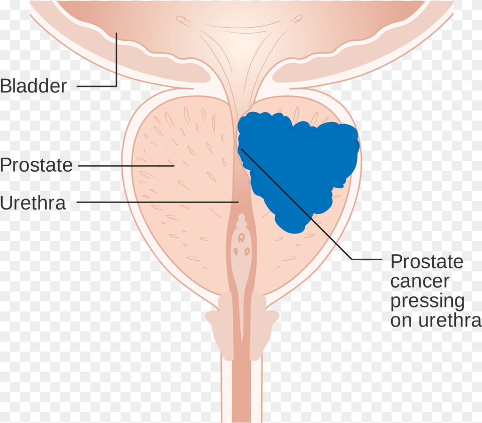 Prostate Cancer Diagramclass Img Responsive Lazyload Free Png