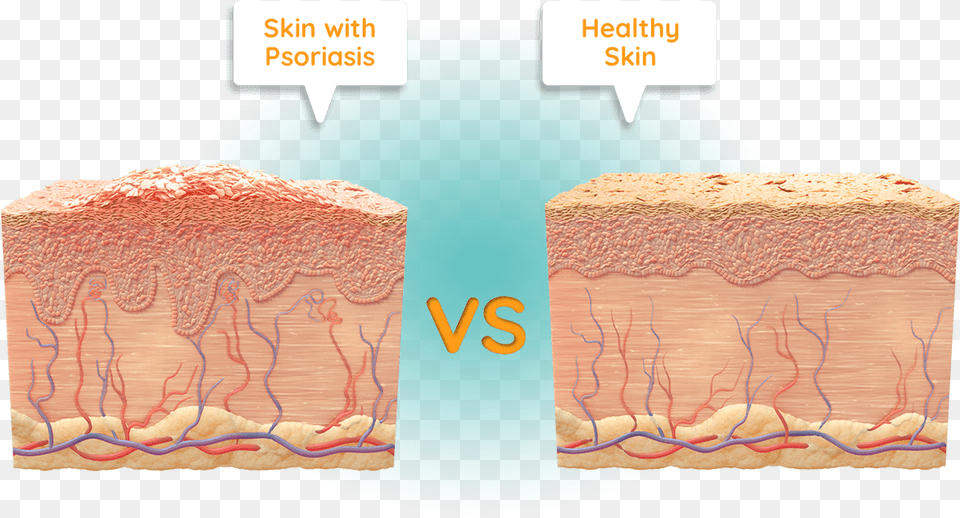 Psoriasis, Brick Png Image