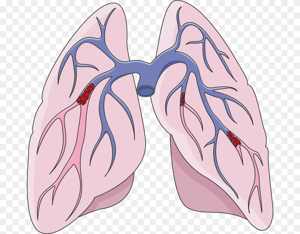 Pulmonary Embolism Clipart, Heart, Accessories, Animal, Fish Free Png Download