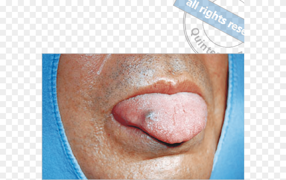Purple Lump In Tongue, Body Part, Mouth, Person, Baby Png