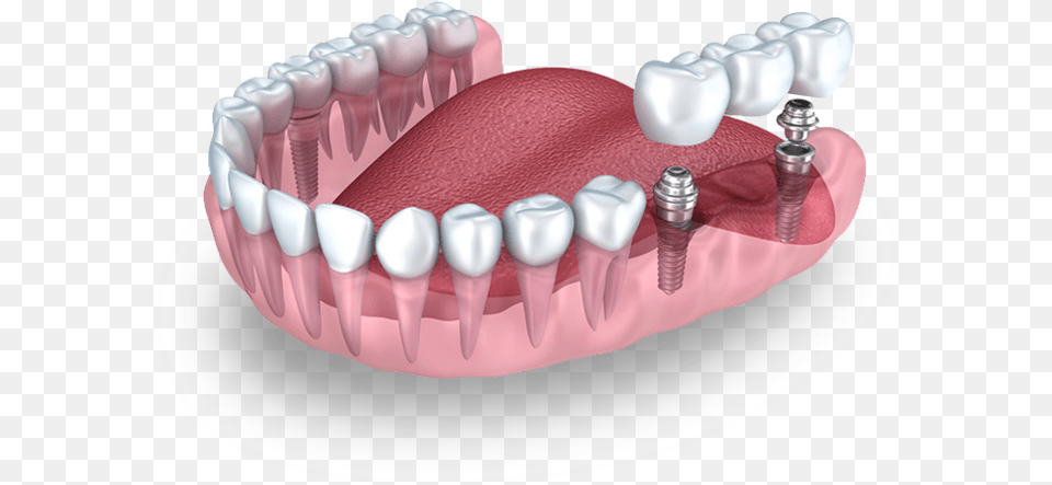 Q And M Home Dental Implant Missing Teeth Much It Cost A Dental Crown, Birthday Cake, Person, Mouth, Food Png