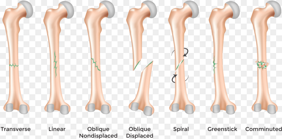 Quotbone Fracturequot Types Of Bone Fractures In Humans, Cutlery, Spoon, Person Free Png Download