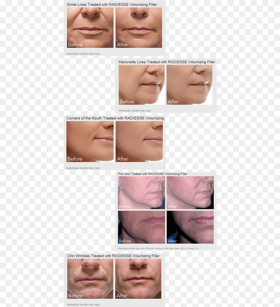 Radiesse Wrinkle Filler Does More Than Just Fill In Radiesse Before And After, Face, Art, Person, Collage Png Image