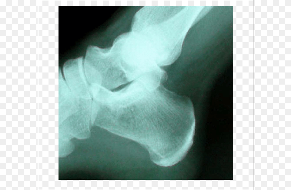 Radiograph Before Shock Wave Therapy Radiography, Person, X-ray Free Png