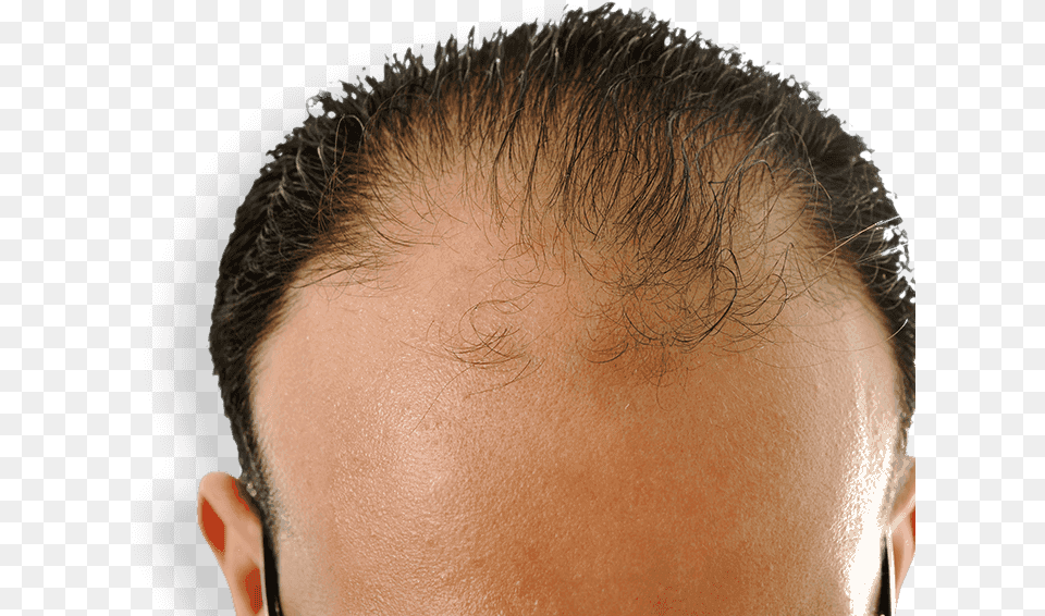 Receding Hairline Will Castor Oil Regrow Hair, Person, Skin, Head, Face Png Image