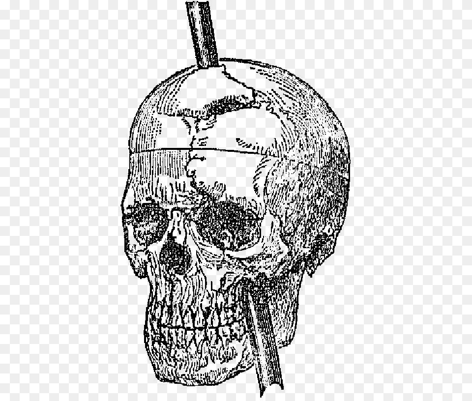 Recovery From The Passage Of An Iron Bar Through The Phineas Gage Skull, Adult, Bride, Female, Person Free Png Download