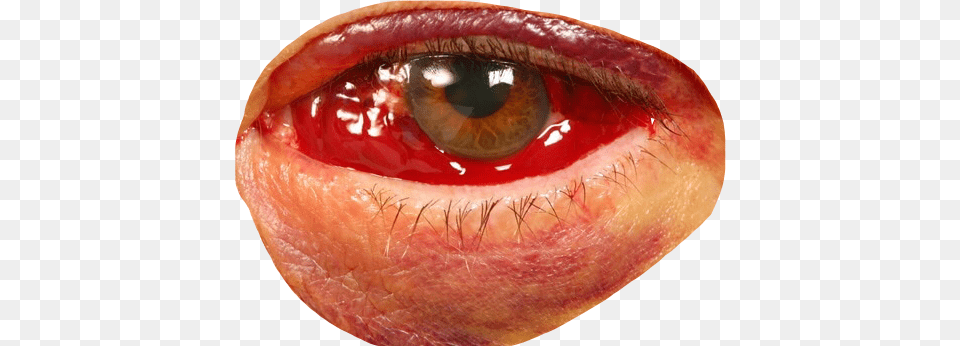 Report Abuse Bloody Eye, Injury, Person, Food, Ketchup Free Transparent Png